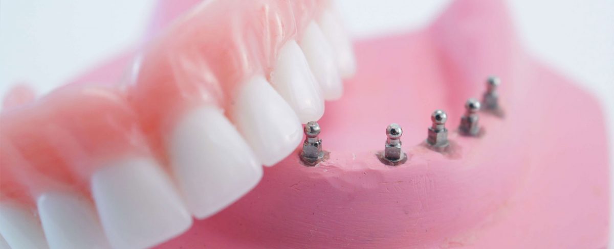 Implant-Retained-Dentures-1200x488.jpg