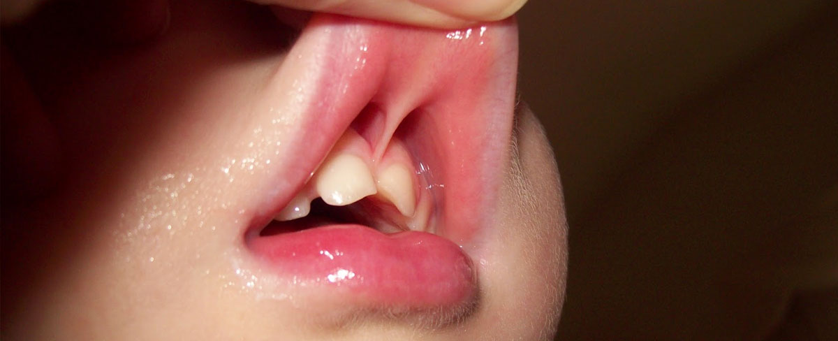 Your Baby's Labial Frenulum