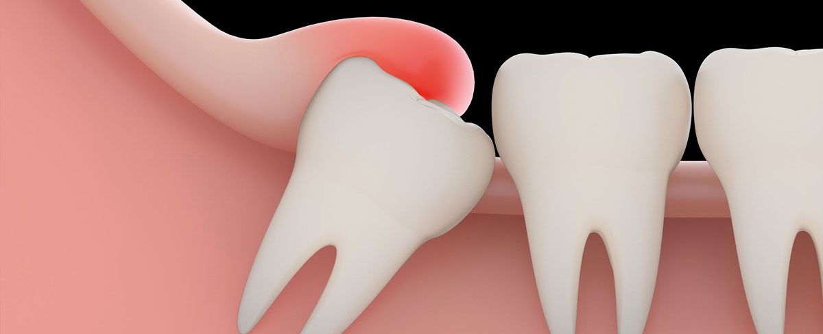 The Single Strategy To Use For Wisdom Teeth Signs